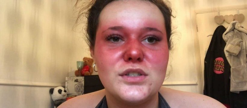 Lupus teen called ‘tomato face’ by bullies reveals gruelling 90-minute ...